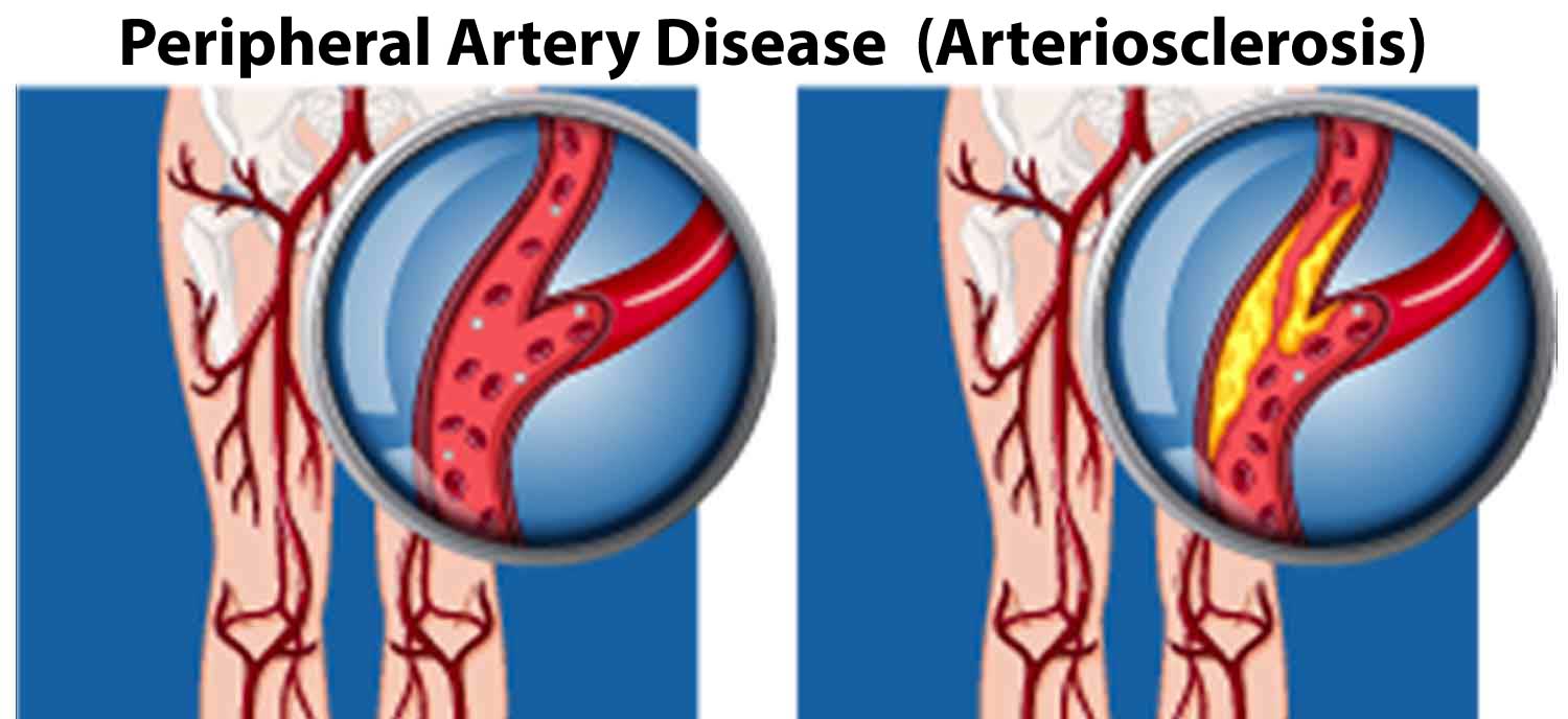 PAD-Peripheral-Artery-Disease
